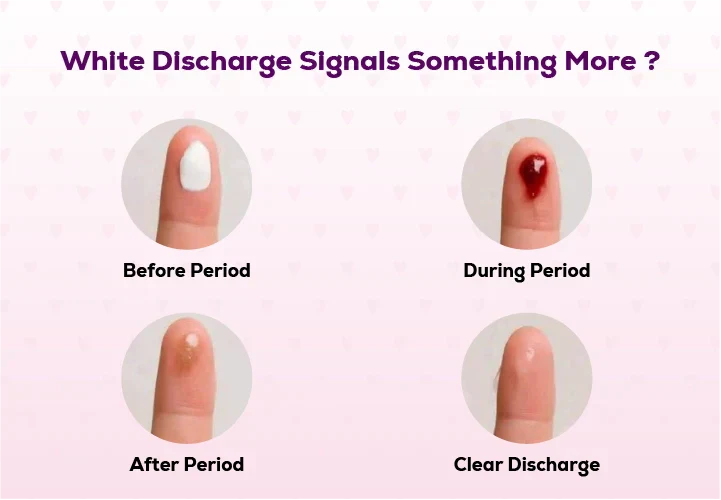 Illustration explaining normal white vaginal discharge and women's intimate health awareness