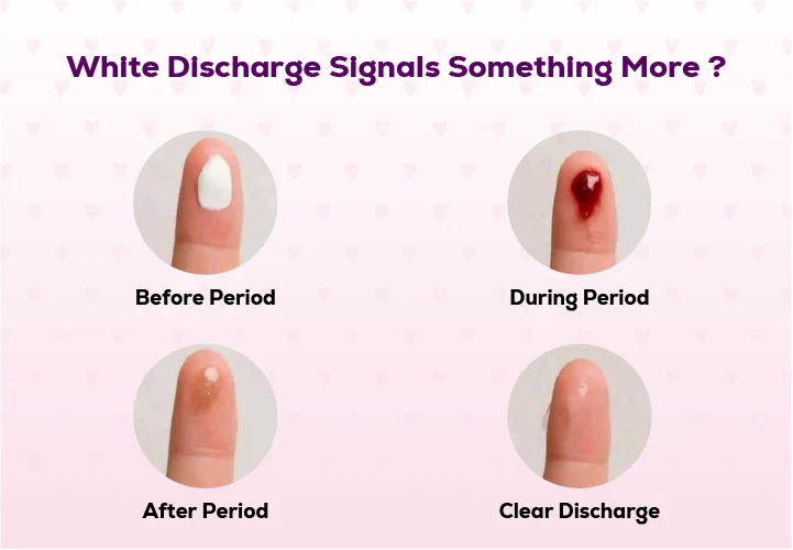 Illustration explaining normal white vaginal discharge and women's intimate health awareness